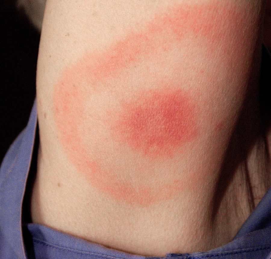 Vědci z Českých Budějovic odhalili způsob průniku borelií do lidského těla