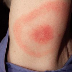 Vědci z Českých Budějovic odhalili způsob průniku borelií do lidského těla